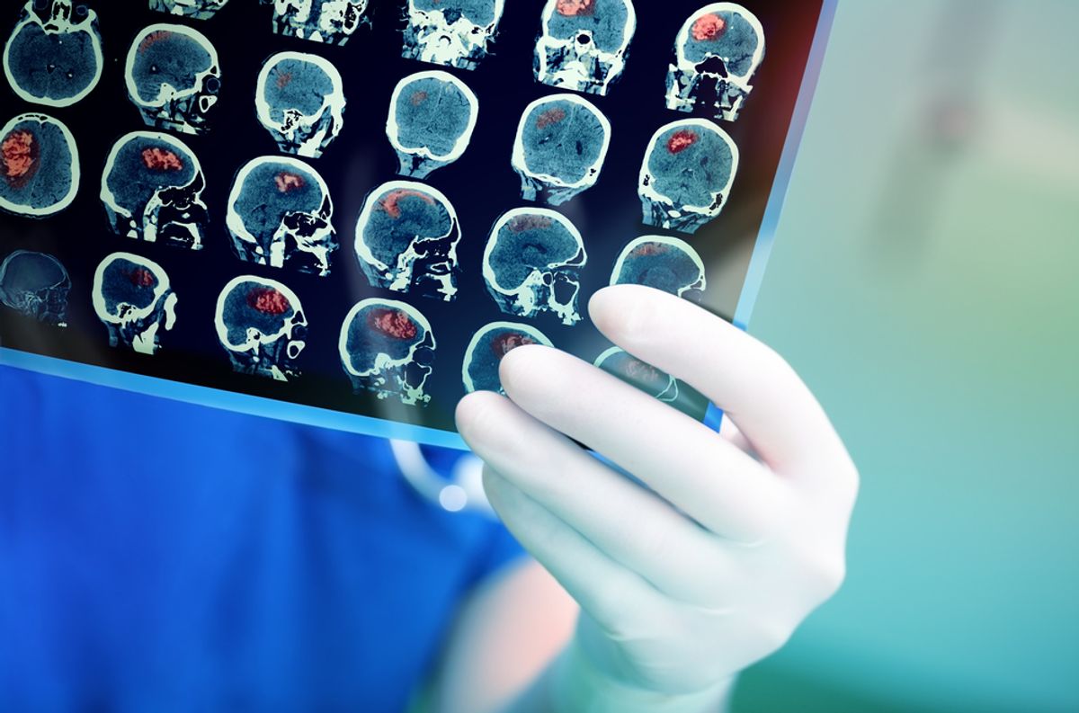 A facut un RMN din cauza durerilor de spate dar medicii i au gasit o tumora cerebrala simptomele neobservate ale unei femei de 38 de ani Am crezut ca o sa mor
