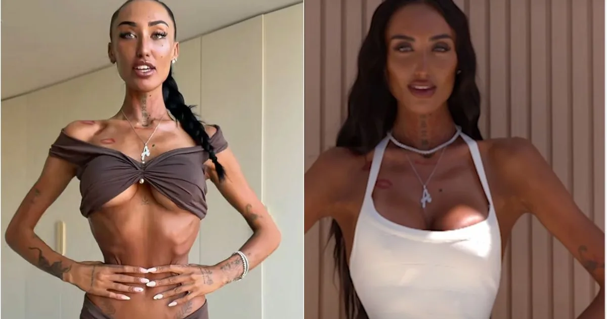 Operația periculoasă pentru talia de viespe, noul trend al influencerițelor